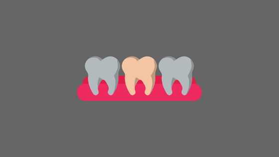 Illustration of three molars